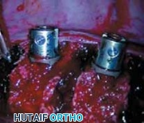 Illustration 24 for Mastering Anterior Interbody Arthrodesis with Instrumentation for Scoliosis