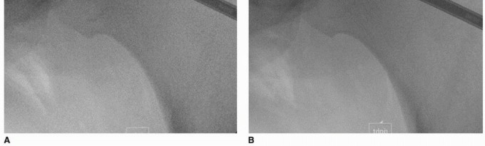 Illustration 33 for Beyond Knee Surg: Hip Arthroscopy for Sports Injuries