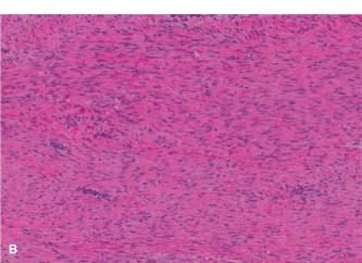 Illustration 3 for Decoding Oncology Cases Osteosarcoma: Diagnosis & Prognosis