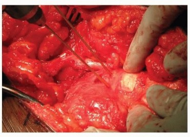 Optimizing Slipped Capital Femoral Correction: Modified Dunn