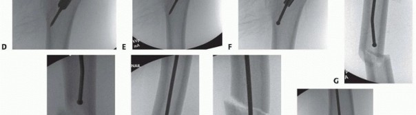 Illustration 15 for Pediatric Femoral Nailing: Targeting the Right aspect of the greater Trochanter
