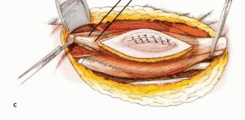 Illustration 20 for Posterior Thigh Resection: Rethinking Outcomes & Limb Sparing