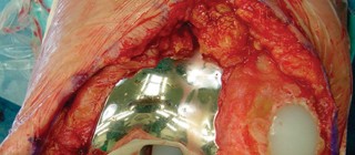 صورة طبية: مراجعة استبدال الركبة الجزئي الفاشل دليلك الشامل للعلاج الناجح في صنعاء