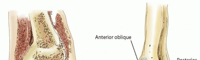 Arthroscopic Treatment of Chondral Injuries and Osteochondritis Dissecans