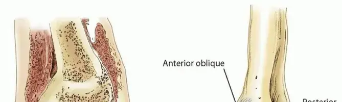 صورة توضيحية لـ التعامل مع إصابات الغضروف والتهاب العظم والغضروف السالخ بالمنظار: دليلك الشامل لاستعادة الحركة