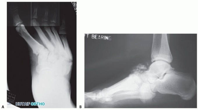 Illustration 21 for Regain Mobility: Surgical Solutions for Charcot Foot Arthropathy