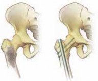 Illustration 19 for Advanced Arthroplasty for Malignant Lesions: Reclaim Your Mobility