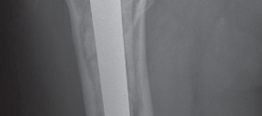 Illustration 46 for Femoral Stem Revision: Posterior Approach for Better Outcomes