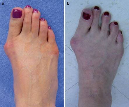 Illustration 58 for First Metatarsal Surgery: Expert Solutions for Foot & Ankle Pain