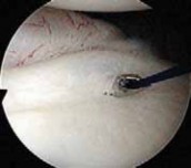 Illustration 19 for Regain Stability: Anterior Shoulder Instability Arthroscopic Fix