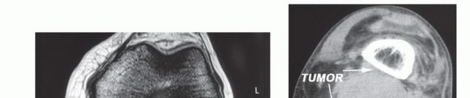 Illustration of greater saphenous vein - Dr. Mohammed Hutaif