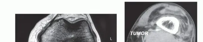 استئصال الأورام المعقدة في الحفرة المأبضية وحماية الوريد الصافن الكبير: دليل شامل للمرضى مع الأستاذ الدكتور محمد هطيف