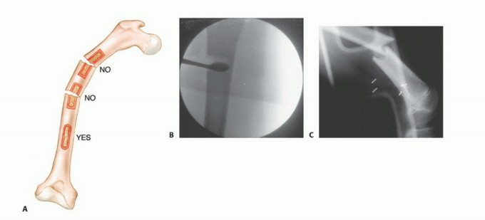 Illustration 40 for Precision Biopsy of Musculoskeletal Tumors for Accurate Diagnosis