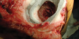 Illustration 17 for Porous Metal Cones: Biologic Fixation for Severe Bone Loss