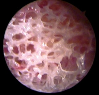 Illustration 22 for Cemented Femoral Stem Figures: Surgical Anatomy & Placement
