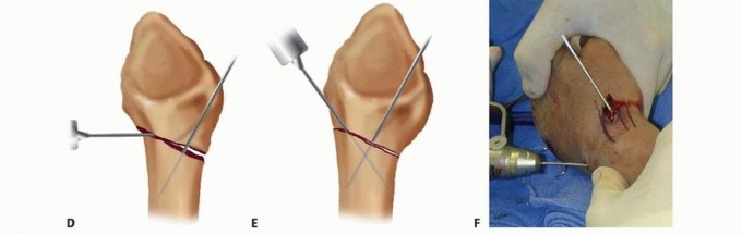 Illustration 12 for Effective K-Wire Fixation: Distal Radius Fractures Without External Fixation