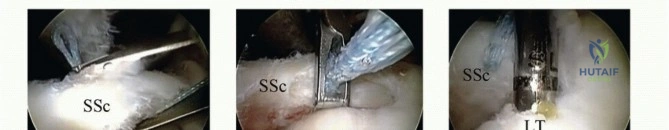 Overlooked Tears? Advanced Treatment of Subscapularis Tears