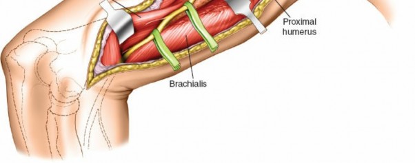 Illustration 70 for Mastering the Approach to the Distal Humerus: Safety & Skills