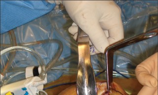 Illustration 8 for Minimal Incision Total Knee: Experience Faster Healing