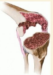 Illustration 3 for Femoral Bone Loss: Metal Augments for Revision Knee Success