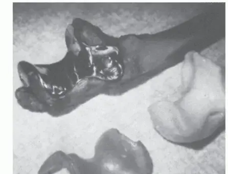 استبدال مفصل الكوع: دليل شامل للمرضى لاستعادة الحركة وتخفيف الألم مع الأستاذ الدكتور محمد هطيف