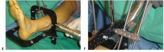 Illustration 61 for Mastering Midfoot Arthrodesis: Protect the Deep Neurovascular Bundle