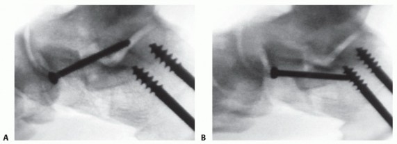 Illustration 26 for Lateral Column Lengthening: Relieve Flatfoot Pain & Correct Deformity