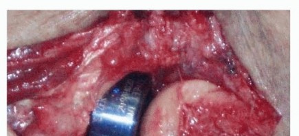 Illustration 25 for Restore Stability & Motion: Fixation of Fracture-Dislocations