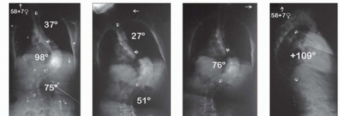 Column Resection for Severe Deformity: The All-Posterior Approach