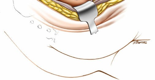 Illustration 134 for Pelvis & Acetabulum Approaches: Unlocking the Posterior Superior Iliac