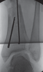 Illustration 44 for Optimal Nailing of the Tibia: Techniques for Challenging Fractures