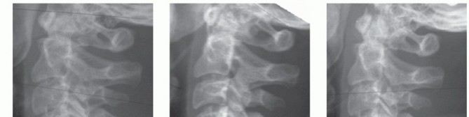 Illustration 31 for Master Techniques for Cervical Fracture Reduction: Type III & More
