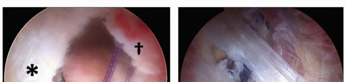 Illustration 36 for Beyond Knee Surg: Hip Arthroscopy for Sports Injuries