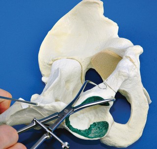 Illustration 48 for Bernese PAO: Unlocking the Procedure with Level V Evidence Insights