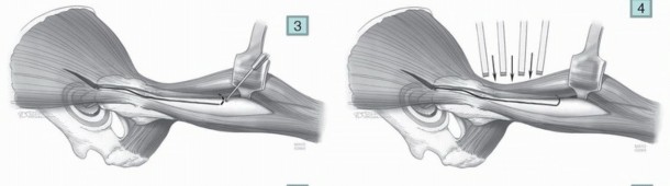 Illustration 10 for Mastering Component Removal: Extended Trochanteric Osteotomy