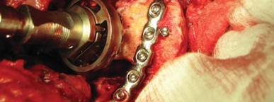 Illustration 28 for Navigating Early THA for Fractures of the Acetabulum