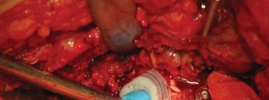 Illustration 31 for Navigating Early THA for Fractures of the Acetabulum