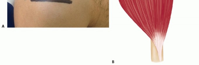 Illustration 6 for Surgical Approaches to Shoulder & Elbow: Pearls and Pitfalls