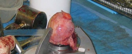 Illustration 13 for Expert Bone Grafting for Primary Total Hip Replacement Success