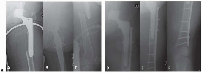 Illustration 24 for Mastering Fixation of Periprosthetic Fractures of the Femur