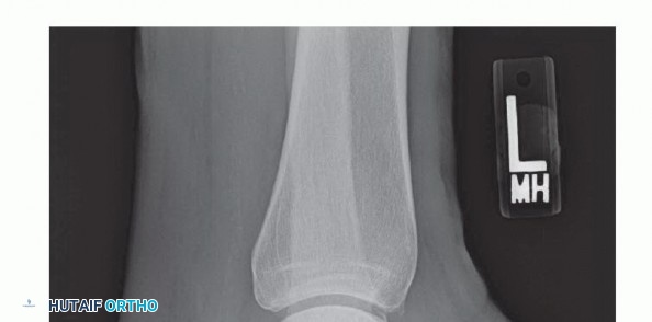 Relieve Haglund's Pain: Endoscopic Treatment for Bursa and Paratenon