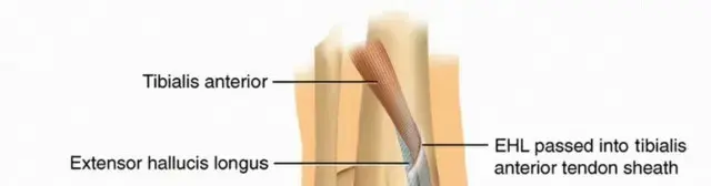 تمزق وتر الظنبوب الأمامي: الدليل الشامل للمرضى مع الأستاذ الدكتور محمد هطيف