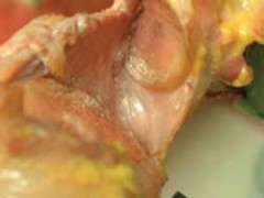 Illustration of anterior shoulder instability arthroscopic - Dr. Mohammed Hutaif