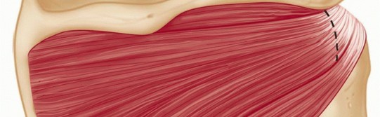 Illustration 13 for Mastering the Treatment of Recurrent Posterior Shoulder Instability