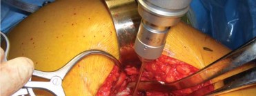 Illustration 91 for Successful Total Hip Replacement in Developmental Dysplasia