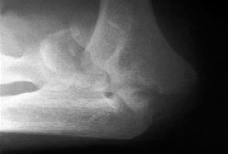 Posttraumatic Elbow Arthritis in Young Adults: Comprehensive Management Strategies