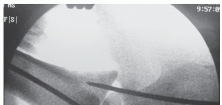 Illustration 42 for Unlock Stability: Medullary Nail Fixation for Tibiotalocalcaneal Arthrodesis