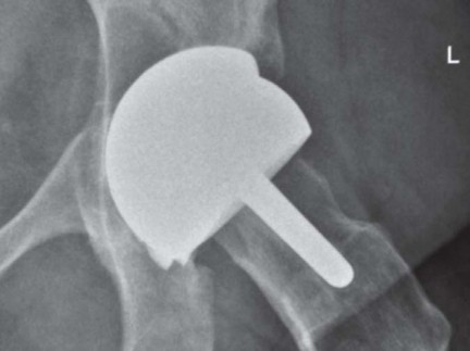Illustration 12 for Minimizing Risks: Computer Navigation in Hip Resurfacing Arthroplasty