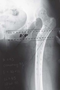 Illustration 27 for Successful Total Hip Replacement in Developmental Dysplasia