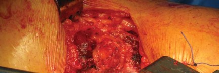 Illustration 44 for Kinectiv® Stem: Modular Necks for Primary THA Success